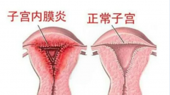 炎症会影响试管吗？别小看，悄悄拉低着床成功